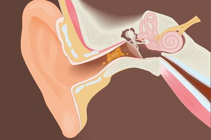 Ráy tai dẫn tới nghe kém dẫn truyền