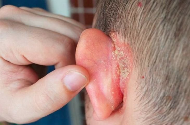 Chàm tai là một bệnh về tai thường gặp những lại dễ bị bỏ qua