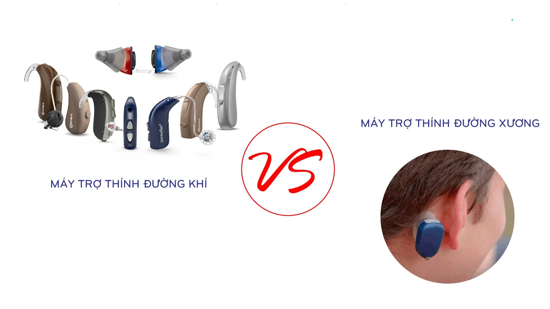 Chọn máy trợ thính đường khí hay đường xương